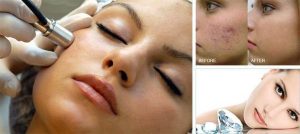 MICRODERMABRASION-DIAMONDTOME-Facial Skin Treatment