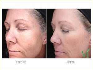 ANTI-AGING VI PRECISION PLUS PEELS