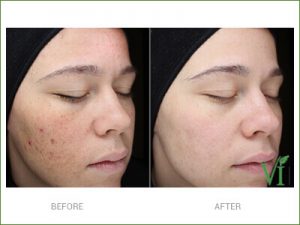 Acne-VI PURIFY WITH PRECISION PLUS